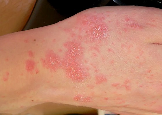 Jak na roztoče a alergie - Unhošť